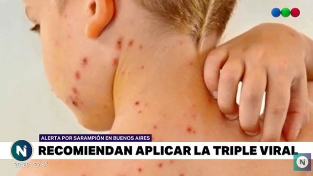 Resultado de imagen para sarampion