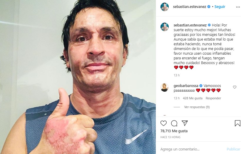 Sebastián Estevanez mostró cómo quedó su rostro tras su terrible accidente
