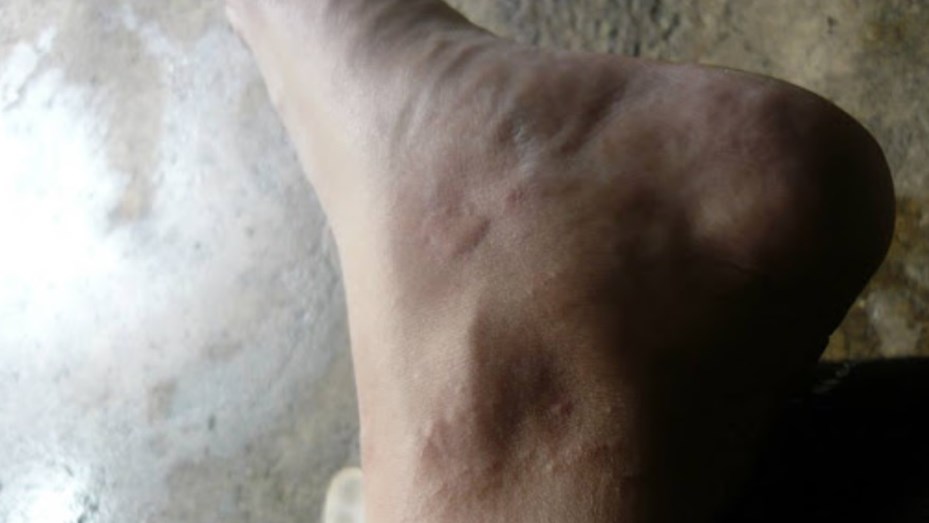 picadura